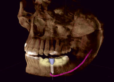 歯科用CTのインプラントシュミレート画像