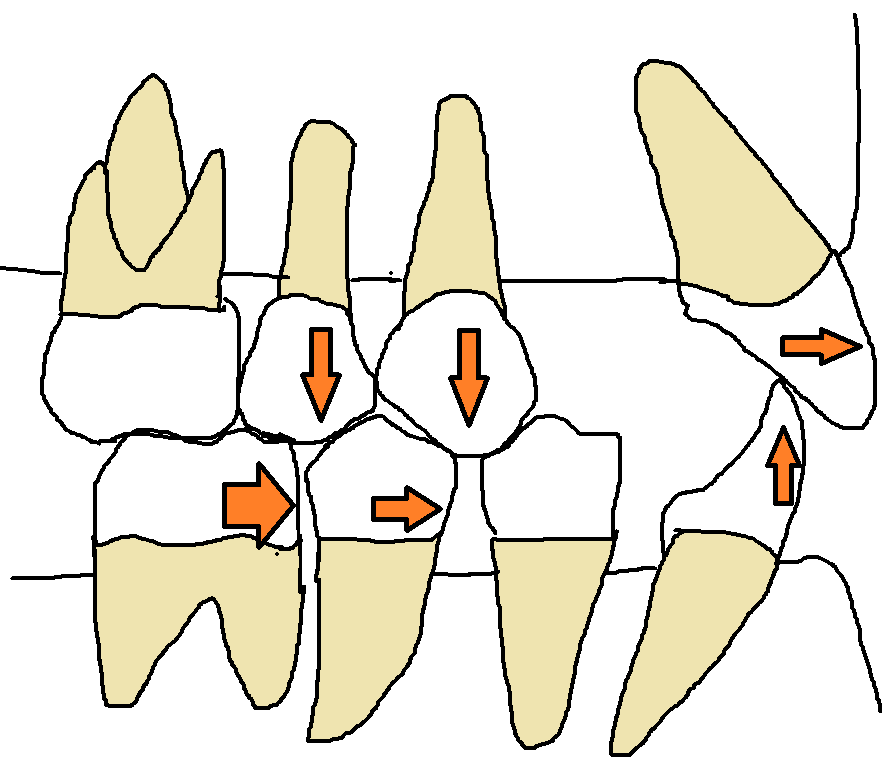 歯周病患者の病的な歯の移動