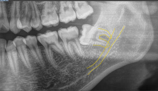 黄色い管のようなものが下歯槽神経です。親知らずの根が近接している事がわかります