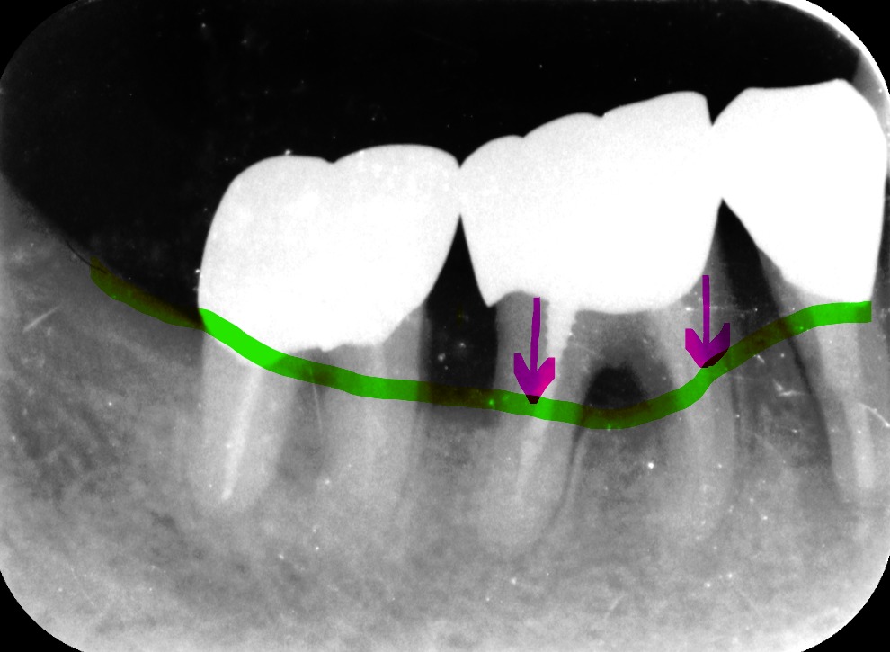 歯周病の進行した歯