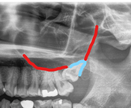親知らずの歯根が上顎洞に飛び出ているケース