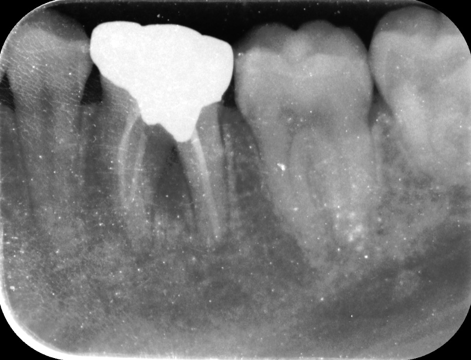 浜松市内の歯科医院にて抜歯と言われた歯のレントゲン