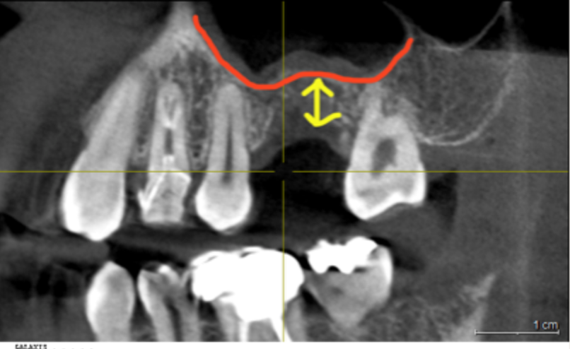 上顎臼歯部のCT画像