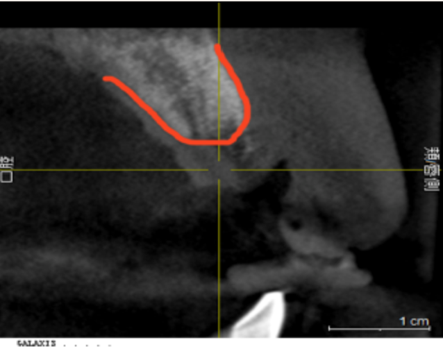 上顎前歯部歯槽骨への骨造成後のCT画像